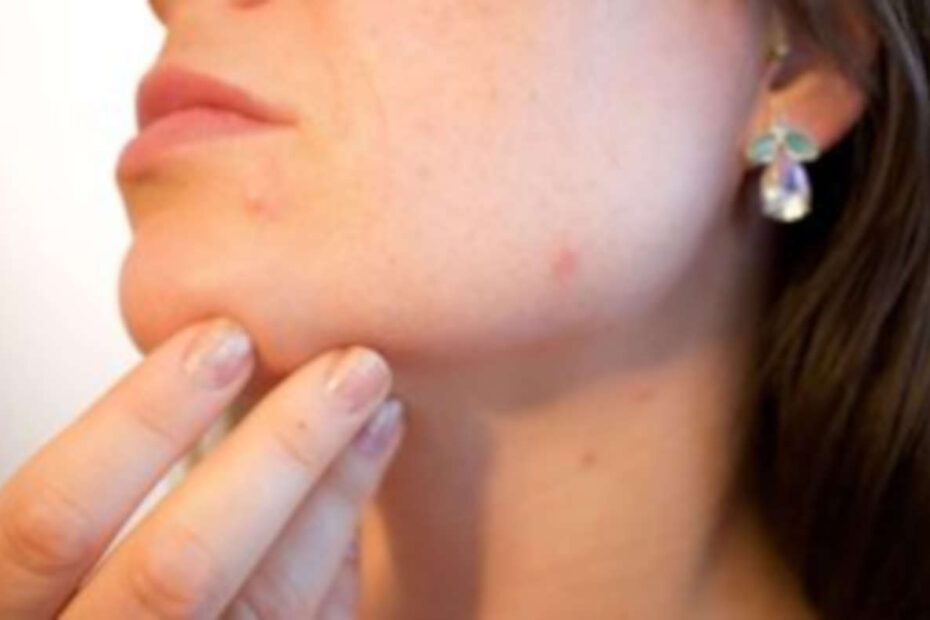 Acne o que fazer - destacada