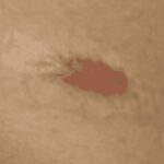 Óleo de rosa mosqueta atenua cicatrizes e queloides - destacada