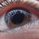como prevenir o glaucoma