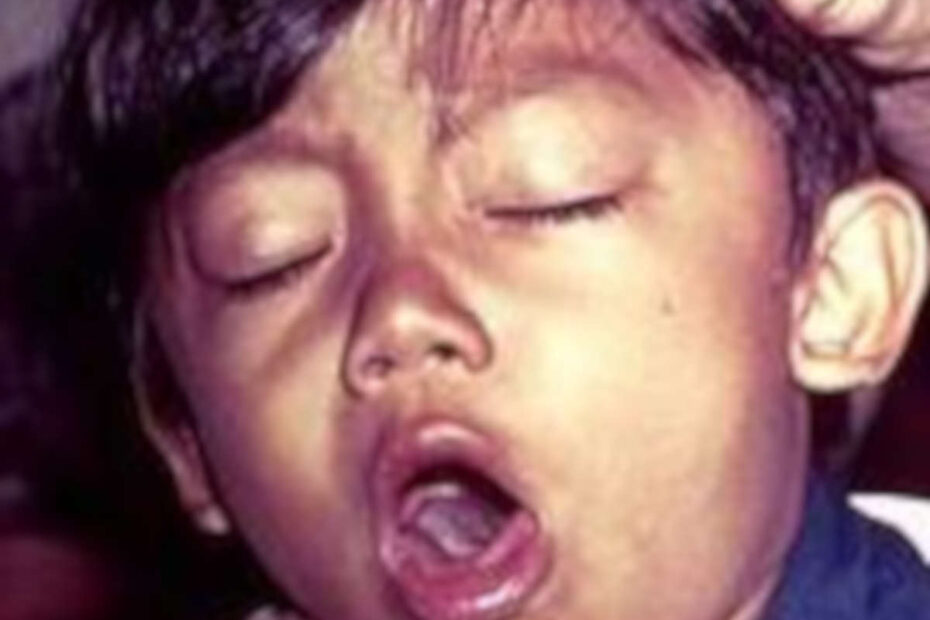 Coqueluche. Mãe proteja seu bebê! - destacada