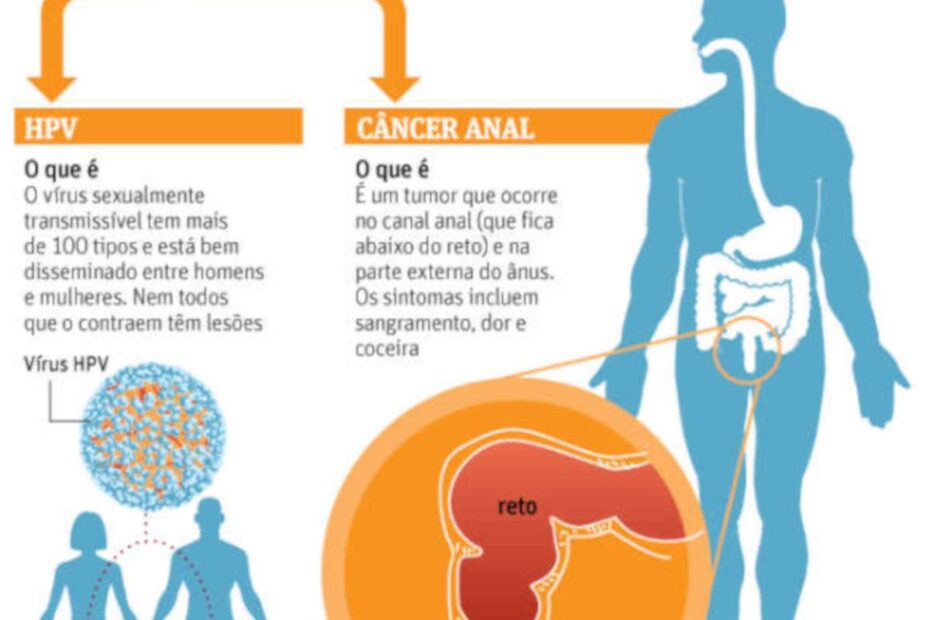 Passa a ser indicada a vacina contra HPV para câncer anal - destacada