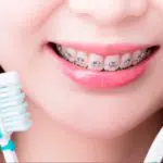 Cuidados indispensáveis na hora de colocar o aparelho