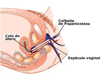 Introdução do espéculo no papanicolau